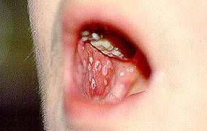 Herpes simplex infection