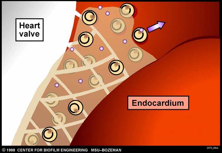 Cells of Staphylococcus epidermidis causing devastating disease as they grow on...