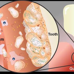 dentalinflammation.jpg