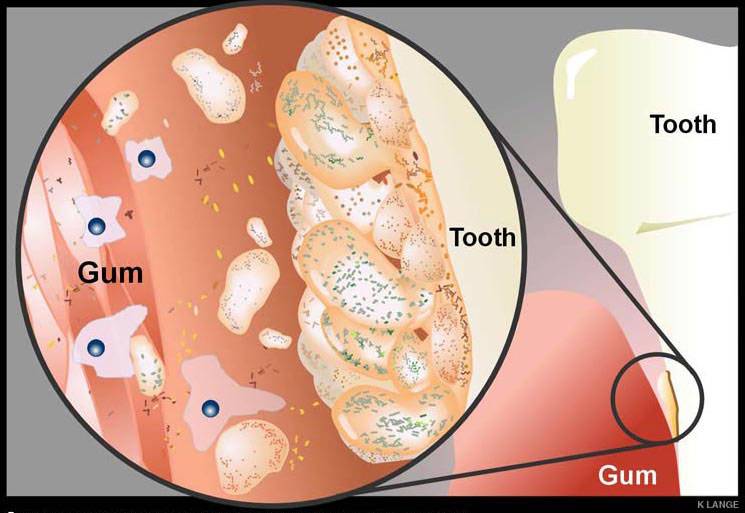 Role in gingivitis and periodontal disease